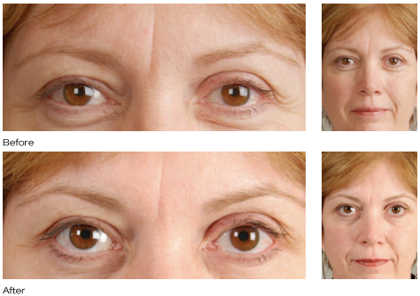 Botox Cosmetic results photo 3