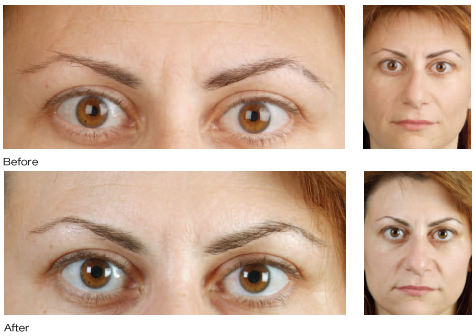 Botox Cosmetic results photo 4